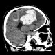 Intracerebral hemorrhage, semioval center: CT - Computed tomography